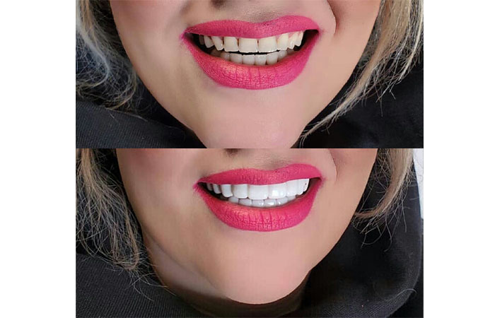 عکس محصول لمینت متحرک دندان snap on smile سفید و منظم کننده دندان